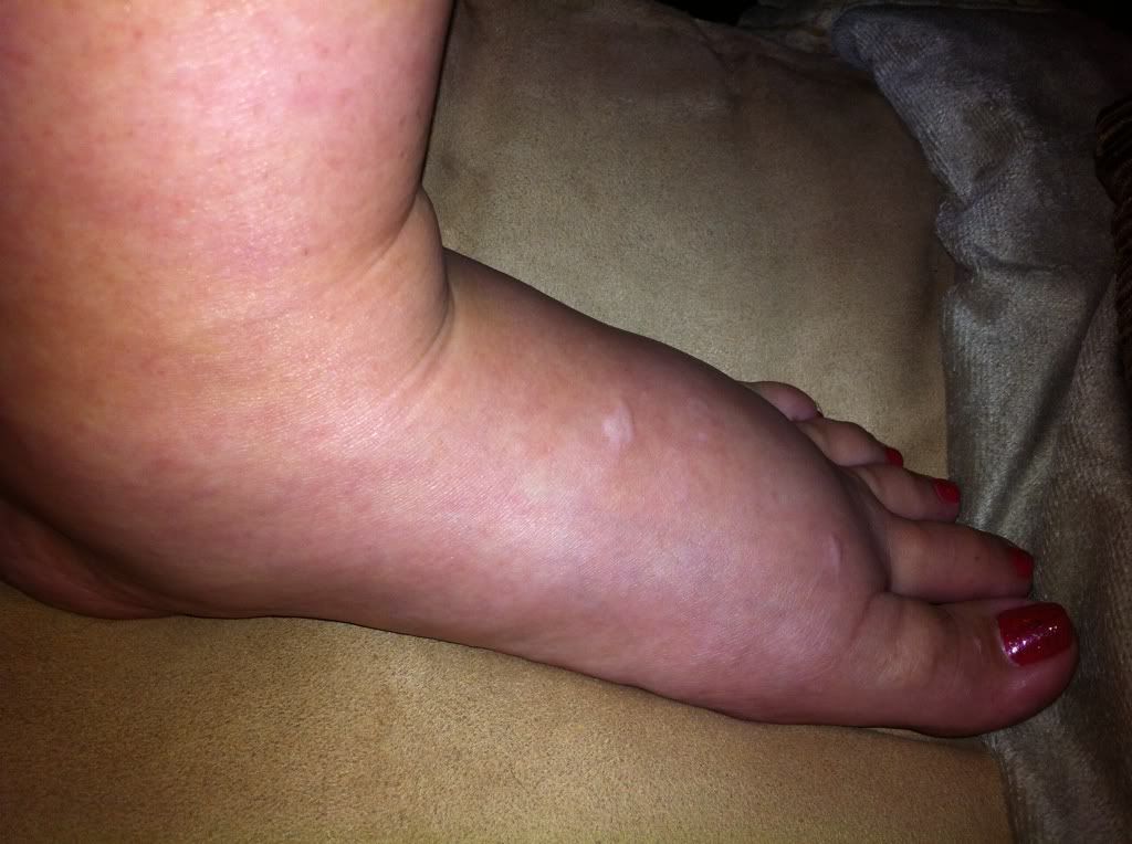Preeclampsia Feet Swelling